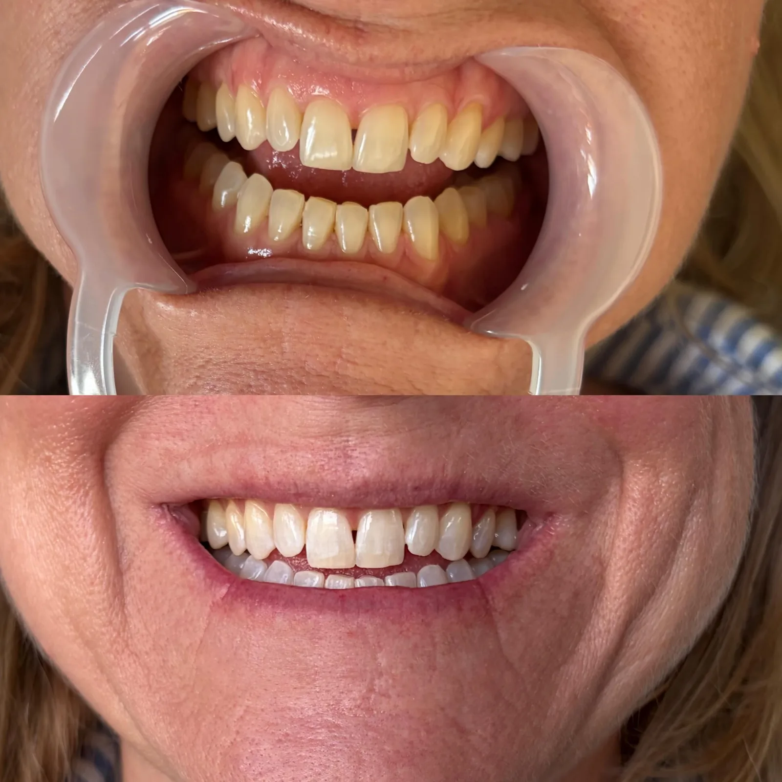 Client's teeth in a retractor before whitening, and the same smile after one session