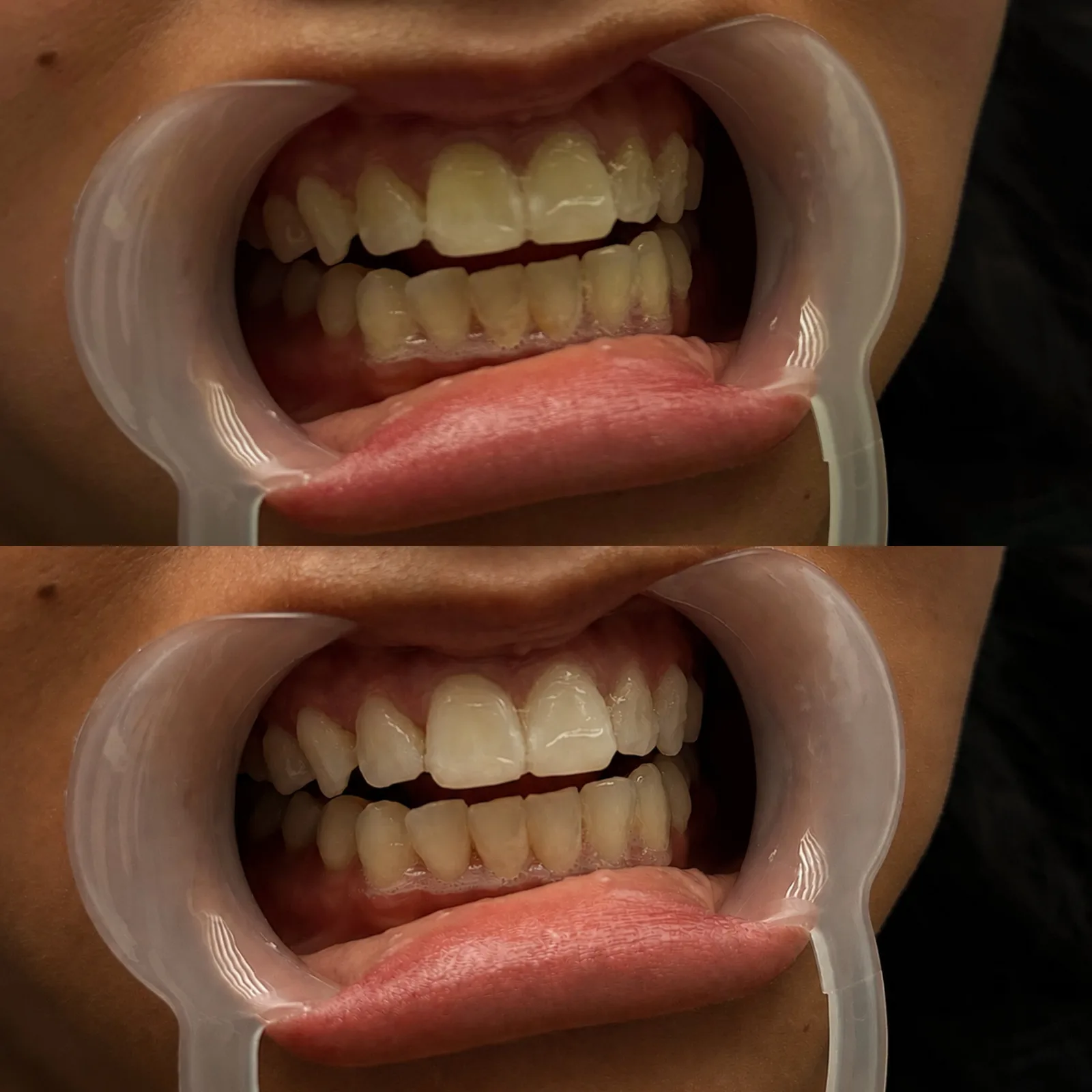 Client's teeth in a retractor before whitening, and the same smile after one session