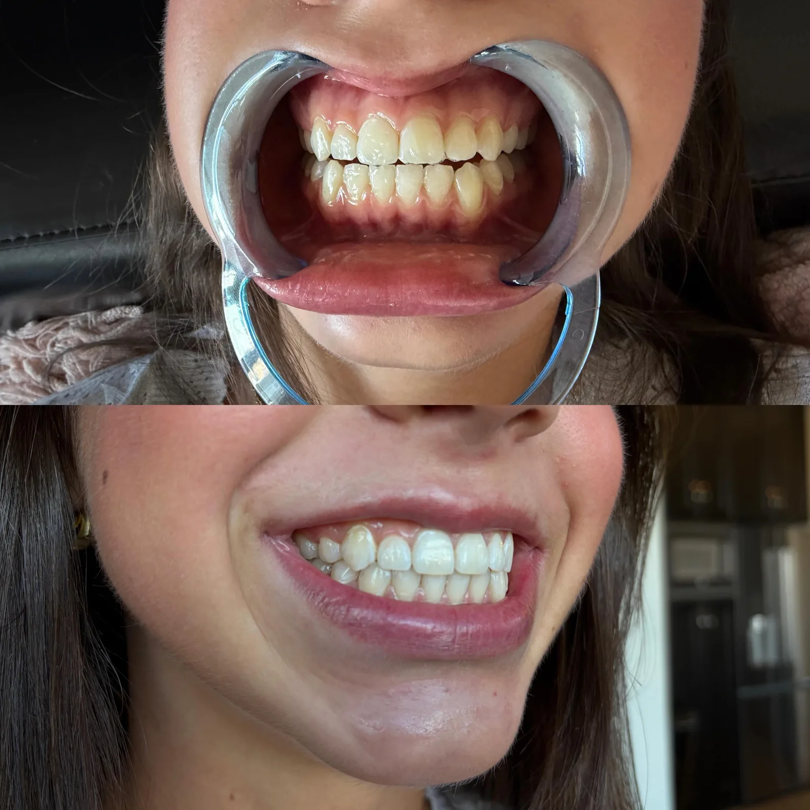 Client's teeth in a retractor before whitening, and the same smile after one session
