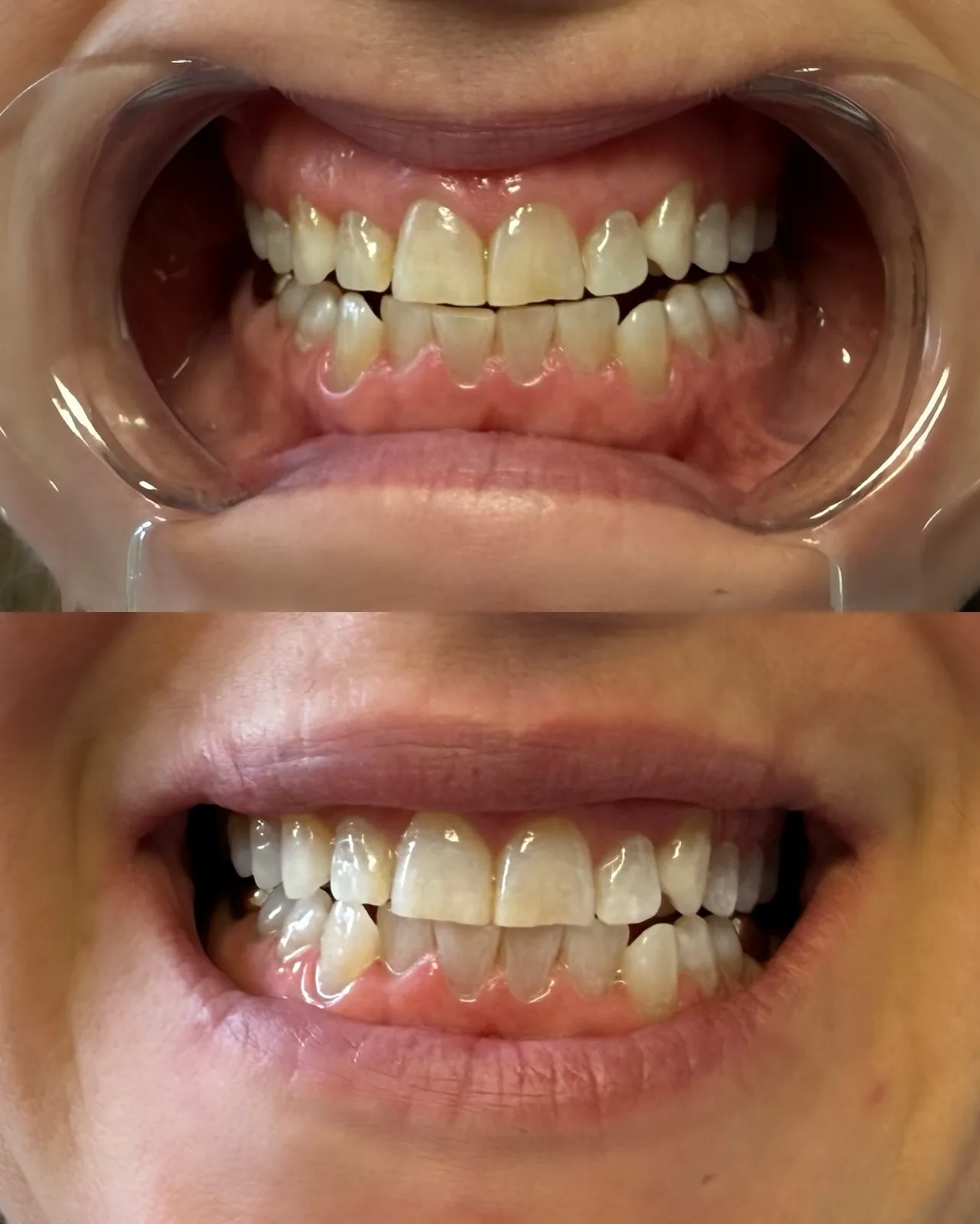 Client's teeth in a retractor before whitening, and the same smile after one session