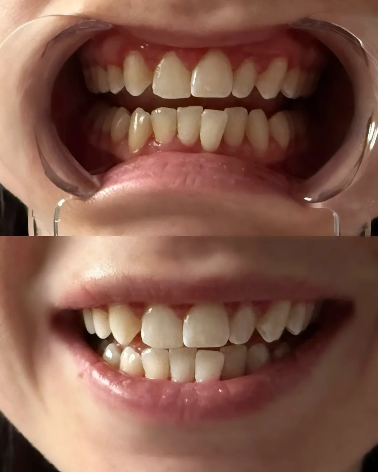 Client's teeth in a retractor before whitening, and the same smile after one session